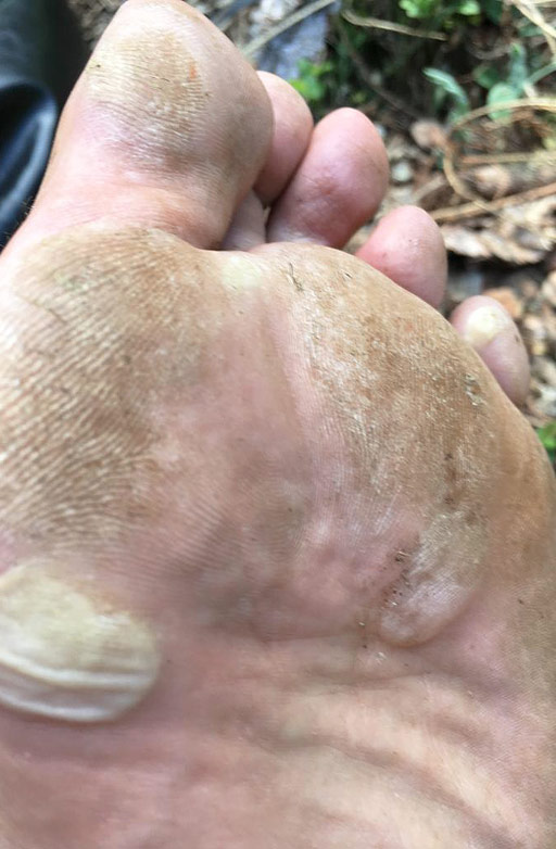 Lots of blisters on a foot.